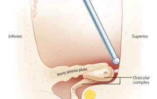 While removing the atretic plate, care must be exerted not to drill on the ossicles, as the transmitted vibration may cause cochlear damage.
