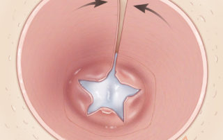 The skin graft is placed with the seam anterior so that any exposed mastoid air cells are fully covered.