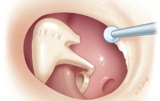In completing the canal excavation, care must be taken posterior-inferiorly because in atresia, the facial nerve may lie lateral to the tympanic annulus.