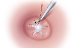 The triangles are smoothed on the fascial graft. Note that the graft is tucked firmly into the margins of the tympanic ring.