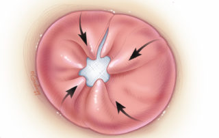 The excess skin graft is folded over in anticipation of meatoplasty.