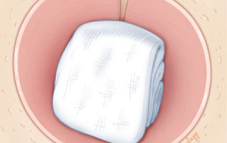 Strip gauze impregnated with antibiotic ointment in place.