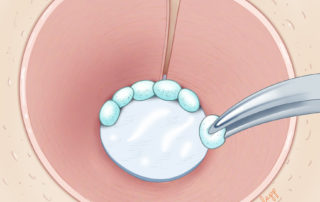 Absorbable gelatin sponge packing may be placed lateral to the Silastic sheet. For ease of removal in a young child, pieces may be larger than depicted here.