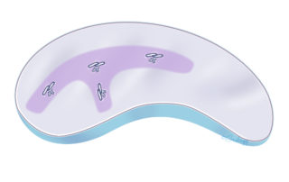 View of the undersurface: the cartilage construct is lifted away from the silicone block, the needles cut, and the wire sutures are twisted together, trimmed, and ends turned down onto the undersurface of the cartilage. As each cartilage piece is added to the construct, the silicone block provides the stability needed for suturing.