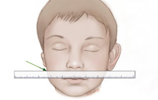 Stage 1 initiates with planning the placement of the reconstructed ear. Standing at the head of the bed, a ruler is used to mark the inferior point of the lobule in symmetry with the nonmicrotia ear. In bilateral microtia, the commissures of the eye and mouth are used as reference points, with the new pinna placed as high as permitted by the demarcation of non–hair-bearing retroauricular skin.