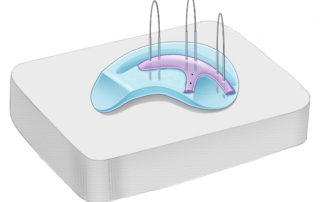 A silicone block is used to secure the cartilage as the individual pieces are constructed together. Double-ended 5.0-steel sutures are used to suture the cartilage. Steel suture is preferred to prevent future migration of cartilage pieces when exposed the tensile strength of the skin. Double-ended steel sutures can be made by hand threading 5.0-steel wire through the eyelet of small, straight cutting needles.