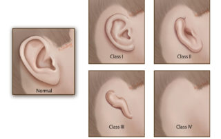 The classes of microtia according to pinna size and subunits affected. For the purpose of this classification, the subunits of the pinna are helix, antihelix, scapha, tragus, antitragus, concha, and lobule. Class 1: a small ear with all of the subunits present, although some may be abnormally shaped; Class 2: a small ear with missing subunits; Class 3: a classic peanut ear with no recognizable subunits except for the lobule; Class 4: anotia (the complete absence of a pinna). Microtia surgery involves multiple stages. Some surgeons employ two stages, others employ three or more. Stages are usually spaced by 3 to 4 months at a minimum. In this chapter, we illustrate a two-staged technique as described by Dr. Francoise Firmin. Foundations from Dr. Burt Brent's four-staged technique and Dr. Satoru Nagata's two-staged technique can be appreciated.