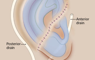 The skin is closed with 6.0 nylon sutures, and the drains are kept to suction for 3 to 5 days. Postoperatively, test tubes are changed every 3 to 4 hours to maintain suction while the construct heals.