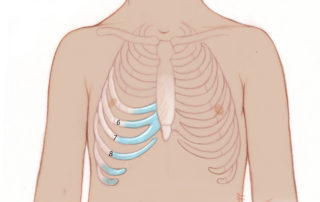 Harvest of rib cartilage is planned from the sixth to ninth cartilage. The ninth cartilage is obtained when prominent. In this technique, cartilage is harvested from the ipsilateral side of the microtia ear.