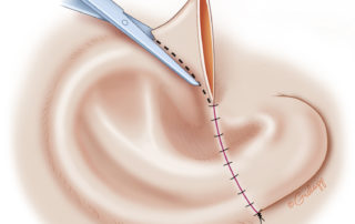 Excess skin is excised. Incisions are hidden in the natural junction of subunits, and trifurcations of the closure are avoided if possible.