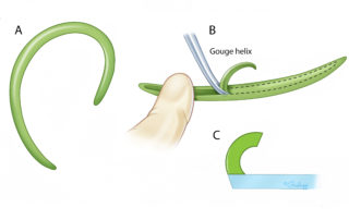 The helix is often carved from the eighth rib cartilage, and is shaped to sit flat on the base plate. The center is gouged to create a curved surface and allow for ease of curvature.