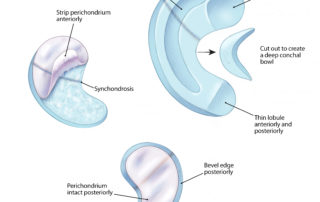 The base plate is prepared by removing the perichondrium on the anterior surface. It is kept intact on the posterior surface. Often, marks are made on the cartilage to delineate the placement of the antihelix and the scapha in the correct orientation. This can be done by inking the cartilage based on a drawing of the opposite ear drawn on X-ray film. The X-ray film is then flipped to show the mirror image, and drawn on paper. The paper is then dipped in water-soluble ink, and stamped on the cartilage. Carving begins with reducing the lobule and gouging the scapha. Then, the triangular fossa can be deepened. Posteriorly, the edge of the cartilage is beveled so that the back surface of the ear is sloped.