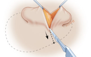 The posterior skin is incised to allow the transposition of the lobule to the new location.