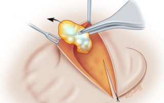 The cartilage remnant is removed. In many cases, dissection of the cartilage remnant is not a trivial dissection and requires a meticulous degloving of the cartilage while maintaining skin flap integrity and vascularity.