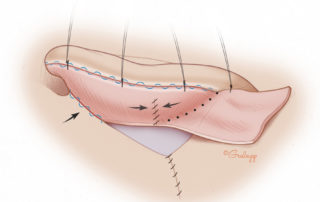 Excess skin graft not needed for the posterior surface of the pinna is trimmed and saved to cover the mastoid defect. This creates a suture line in the sulcus so that the graft does not cross the sulcus. Grafts which cross the sulcus tend to blunt, whereas the suture line tends to create a deeper and more natural sulcus.