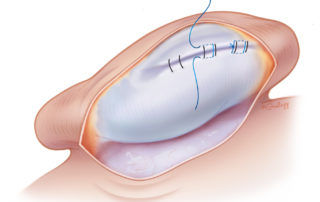An axial view of pinna demonstrating temporary and permanent suture placement to create the antihelical fold. Note that the permanent suture (shown here in blue) does not violate the skin anteriorly, but does penetrate the perichondrium.