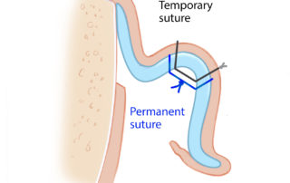 Two permanent mattress sutures are placed through the auricular cartilage and anterior perichondrium, with care taken to avoid violation of the skin, using the method of Furnas. These are then secured to the mastoid periosteum. Anterior displacement of the conchal cartilage is avoided by placing these sutures posteriorly on the mastoid.