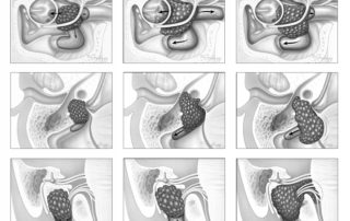 Glomus jugulare tumor. Moderate-size glomus jugulare tumor with a typical extension into the hypotympanum (left). The tumor also extends proximally within the lumen of the sigmoid sinus and distally into the upper portion of the jugular vein. (Center) More extensive glomus jugulare tumor with erosion of both carotid and fallopian canals. (Right) Glomus jugulare tumor with extension into the posterior cranial fossa and upward erosion into the floor of the internal auditory canal.