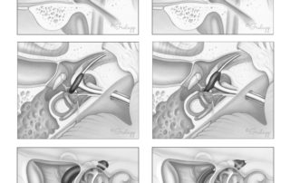 Schwannoma of the facial nerve involving the labyrinthine, geniculate, tympanic, second genu, and upper mastoid segments of the nerve (left). The tumor lies entirely confined within the fallopian canal. Schwannoma of the tympanic segment of the facial nerve spanning from the second genu to the lateral aspect of the geniculate ganglion (center). The tumor is fusiform and largely conforms to the fallopian canal.