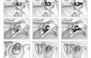 Intralabyrinthine schwannoma of the vestibule spanning from the oval to round windows (a veritable “vestibular schwannoma”) (left). (Center) An inner ear schwannoma with involvement of the posterior and superior semicircular canals lumens as well as the base turn of the cochlea. (Right) A schwannoma involving both the inner ear (vestibule and cochlea) and the fundus of the internal auditory canal. Most commonly, this represents a vestibular nerve tumor (acoustic neuroma) which has penetrated through the lateral terminus of canal.
