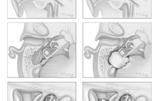 An early papillary adenomatous lesion arising from the rugose portion of the endolymphatic sac (left). These tumors may grow laterally into the mastoid, posteriorly into the posterior cranial fossa, or along the vestibular aqueduct to the inner ear. (Right) An advanced endolymphatic sac tumor with extensive mastoid involvement, erosion of the semicircular canals, and spread into the posterior cranial fossa and indentation of the cerebellum. In von Hippel–Lindau syndrome, patients may have bilateral endolymphatic sac tumors.