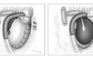 Schwannoma of the tympanic segment of the facial nerve spanning from the second genu to the lateral aspect of the geniculate ganglion. An exophytic mass in the middle ear is present. Such tumors often present with conductive hearing loss accompanied by normal facial function. The tumor may be encountered unexpectedly during a tympanotomy for presumptive otosclerosis.