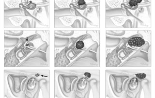 Hemangioma of the geniculate ganglion. Small intraosseous hemangioma situated at the apex of the geniculate ganglion (left). Hemangioma involving the entire geniculate ganglion and proximal segment of the greater superficial petrosal nerve. (Center) The superior aspect of the cochlea is partially eroded. (Right) Geniculate region hemangioma with medially directed growth into the petrous apex. The cochlea is eroded from above.