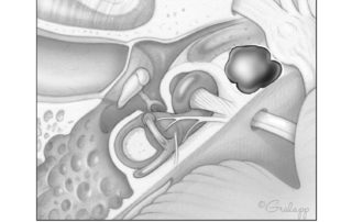 Metastasis to the petrous apex. The marrow space of the petrous apex is the most frequent location for metastases within the temporal bone (e.g., breast, lung, and prostate cancers).