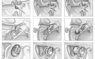Small glomus tympanicum tumor arising from the anterior–inferior aspect of the promontory (left). Glomus tympanicum tumor with growth into the hypotympanum, posterior tympanic spaces (sinus tympani and facial recess), and oval window region with engulfment of the stapes (center). Extensive glomus tympanicum tumor with involvement of the entire middle ear cleft and spread via the aditus-ad-antrum to the mastoid (right).