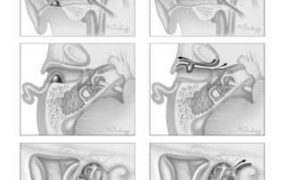 Adenoma of the ear canal. Note the geometric regularity of the lesion and its minimal influence on underlying bone (left). Adenocystic carcinoma of the ear canal. Note the widespread subperiosteal spread in the ear canal and the extensive skull base involvement for a relatively modest size primary lesion (right). A neurotrophic growth pattern, particularly along the intratemporal course of the facial nerve, may develop.