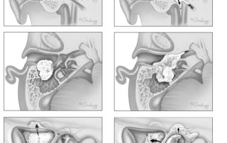 Advanced squamous cell carcinoma of the ear canal with invasion of the middle cranial fossa via the tegmen mastoideum (left). Note the tendency for spread along the dural surface. Advanced squamous cell carcinoma of the ear canal with medial invasion through the middle ear into the otic capsule (right). Spread into the protympanum and along the Eustachian tube brings the tumor into approximation with the intrapetrous carotid artery.
