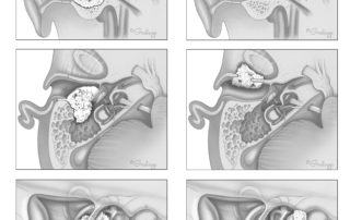 Moderate-size squamous cell carcinoma of the ear canal involving the inferior and posterior aspects of the canal (left). Note the breaching of posterior aspect of the canal into the mastoid. In addition, the floor of the canal is eroded and the tympanic membrane is penetrated. Moderate-size squamous cell carcinoma of the ear canal with an anterior invasion pattern (right). Note the involvement of the condylar fossa and the tendency for invasion anteriorly and inferiorly along the base of skull.