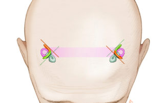 Both lateral semicircular canals are coplanar. Each posterior semicircular canal is coplanar with the opposite superior canal.