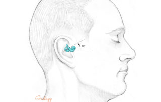 The lateral semicircular canal is tilted upward by 30 degrees.