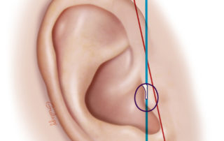 The pinna is tilted posteriorly from the axis of the malleus. Understanding this is important to patient positioning during surgery.