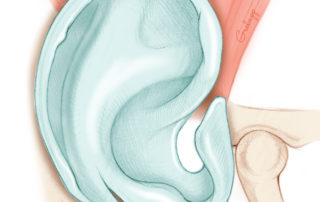 Cartilage skeleton of the auricle. Note the incisura between the crus of the helix and the tragus. This is the location of an endaural incision.
