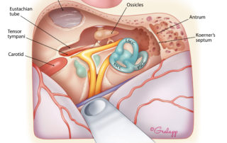 Anatomical dissection of the temporal floor peering from above via the middle fossa approach. EAC, external auditory canal; LSCC, lateral semicircular canal; PSCC, posterior semicircular canal; TMJ, temporomandibular joint; SSCC, superior semicircular canal.