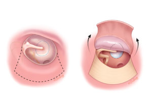 Congenital cholesteatoma characteristically arises from an embryological remnant on the promontory wall anterior to the malleus. Standard posterior tympanotomy is insufficient to expose the anterior aspect of the tympanum.