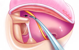 View of the stapes and facial nerve obtained after scutum removal. As removal of disease in this location requires delicacy, obtaining optimal visualization is important.