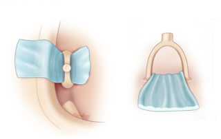 Cholesteatoma matrix under an intact stapes arch creates a technical challenge.