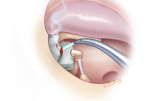 Laser disruption of the ossicular chain in preparation for resection of the cholesteatoma. Note the absorbable gelatin sponge pledget protecting the facial nerve.