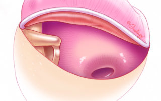 Exposure of the stapes in cholesteatoma surgery often requires removal of a portion of the scutum. As weakening the bony support of the epitympanum by enlarging the epitympanic defect is not desirable in epitympanic cholesteatoma, the smallest amount of bone removal is desirable. This may be facilitated by use of endoscopic assistance.