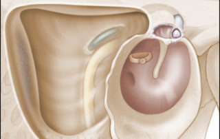 Following resection of the posterior epitympanic cholesteatoma, it is important to open the epitympanum fully to afford visibility anterior to the malleus head to identify potential anterior epitympanic cholesteatoma.