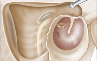 Exposing anterior to the malleus head to identify and remove anterior epitympanic cholesteatoma. Note that the malleus head has been resected. The cog, a bony septum suspended from the tegmen tympani separating the anterior from posterior epitympanum, is also removed.