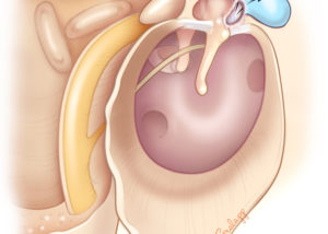 Anterior epitympanic cholesteatoma penetrates anterior to the malleus head and can involve the anterior tympanic segment of the facial nerve. (Used with permission from Jackler RK. The surgical anatomy of cholesteatoma. Otolaryngol Clin NA 1989;22:883–896.)