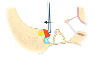 Removing the bone from the posterior annular groove can shallow the sinus tympani and improve access for disease removal. Removing the bone from the posterior annular groove can shallow the sinus tympani and improve access for disease removal.