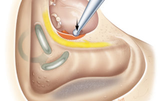 Removing the bone from the posterior annular groove and pyramid (origin of the stapedius muscle) can shallow the sinus tympani and improve access for disease removal. Removing the bone from the posterior annular groove and pyramid (origin of the stapedius muscle) can shallow the sinus tympani and improve access for disease removal.
