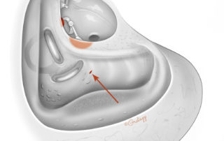Residual cholesteatoma in a perilabyrinthine cell tract. This is generally present when cholesteatoma invades a well-pneumatized mastoid. As most cholesteatomas occur in poorly pneumatized mastoids, this location for residual is not common. Residual cholesteatoma in a perilabyrinthine cell tract. This is generally present when cholesteatoma invades a well-pneumatized mastoid. As most cholesteatomas occur in poorly pneumatized mastoids, this location for residual is not common.