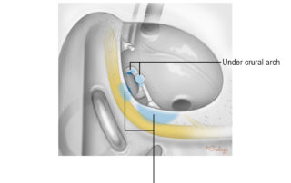 The most common sites of residual cholesteatoma following surgery are under the tympanic segment of the facial nerve, in relation to the stapes and oval window, and in the posterior middle ear spaces (facial recess and sinus tympani). The most common sites of residual cholesteatoma following surgery are under the tympanic segment of the facial nerve, in relation to the stapes and oval window, and in the posterior middle ear spaces (facial recess and sinus tympani).