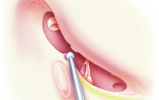 In intact canal wall procedures, cholesteatoma in the facial recess can be removed via the mastoid using a facial recess approach. In canal wall down procedures, the facial recess lateral wall is removed and thus is it readily accessible. In intact canal wall procedures, cholesteatoma in the facial recess can be removed via the mastoid using a facial recess approach. In canal wall down procedures, the facial recess lateral wall is removed and thus is it readily accessible.